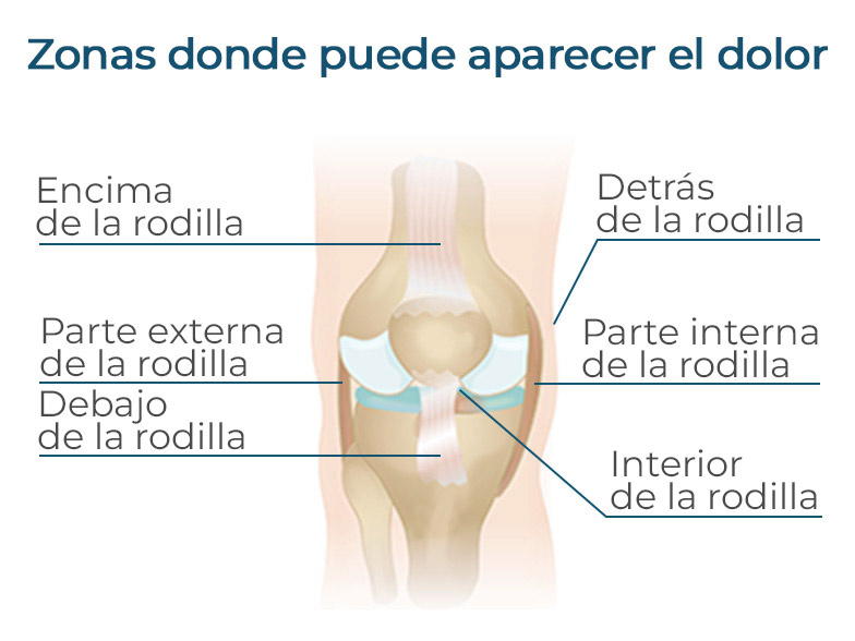 Cncrns_Cndtns-kneepain-chart-392x294@2x.jpg