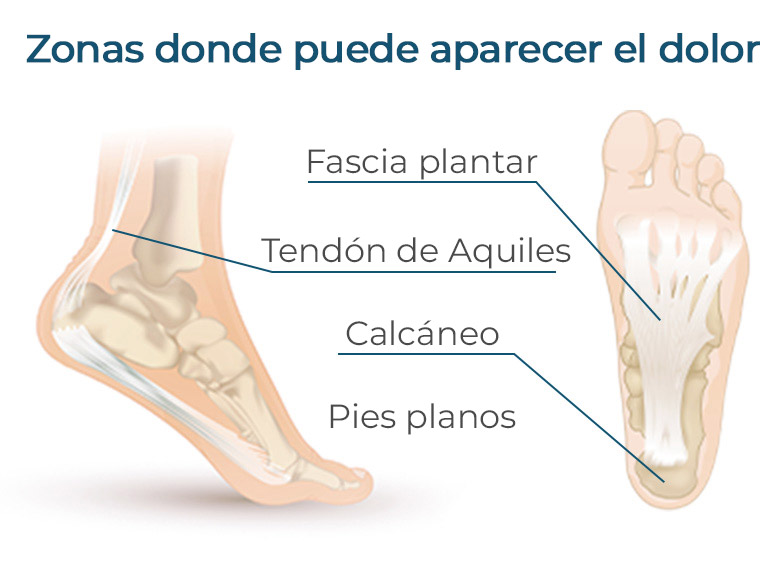 Cncrns_Cndtns-PlantarFasciitis-Chart-392x294@2x.jpg
